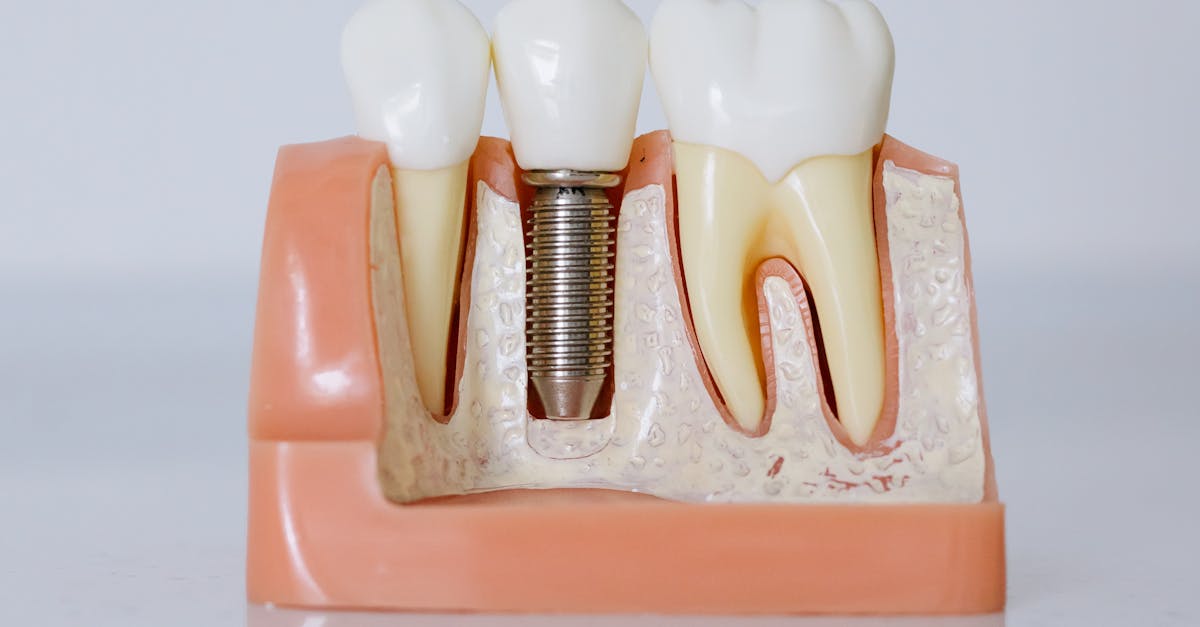 Dental Implants Johnstown